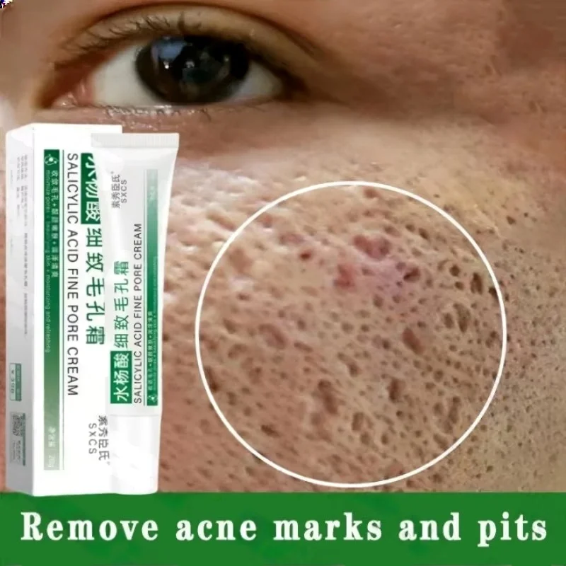 Salicylic Acid Blackhead Remover - Salisilik Asit Gözenek Temizleme Kremi Gözenekleri