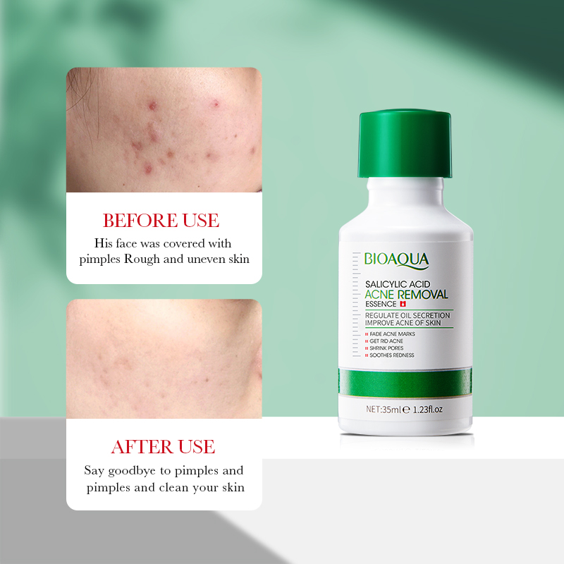 35 ml BIOAOUA Salisilik Asit A - Salicylic Acid Blackhead Remover incelemesi ve fiyatı