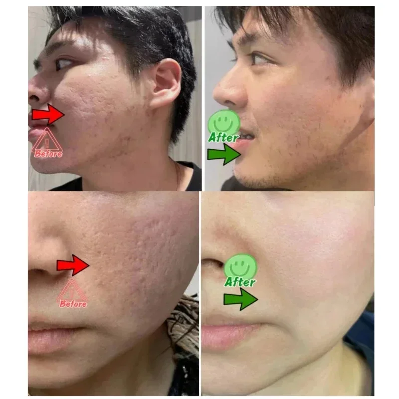 Salisilik Asit Gözenek Temizle - Salicylic Acid Blackhead Remover incelemesi ve fiyatı