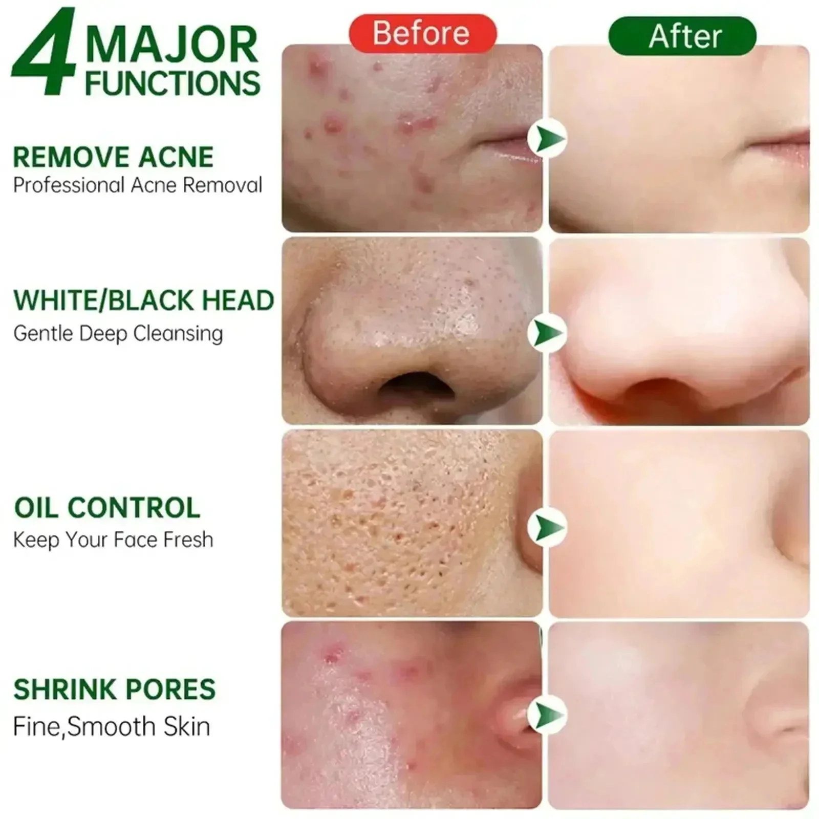 Salisilik Asit Gözenek Temizle - Salicylic Acid Blackhead Remover incelemesi ve fiyatı